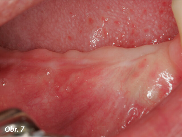 Klinická situace šest měsíců po prvním zákroku.