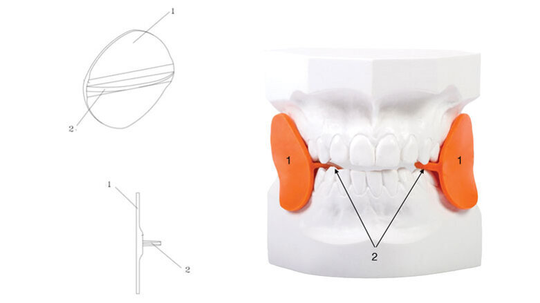 L’abitudine muscolare  come elemento di recidiva: il cross-bite