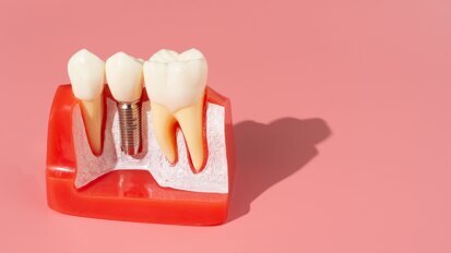 Onderzoek toont risicofactoren voor vroegtijdig implantaatfalen