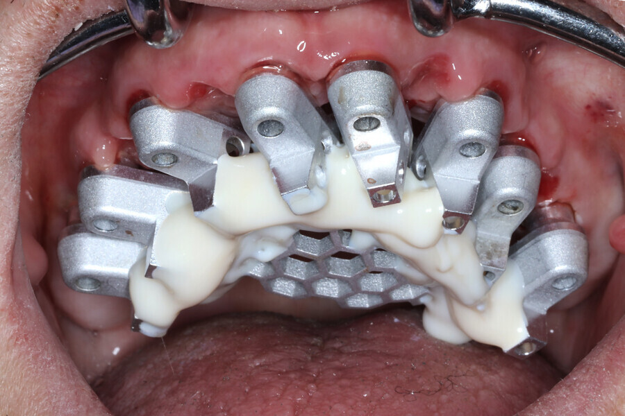 Fig. 15g: Grammetry OptiSplint used to capture implant positions for model fabrication.
