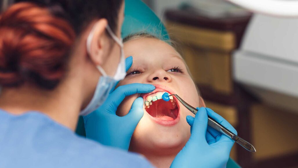 Istraživači pokazuju: Previsoka doza fluorida oštećuje dječje zube