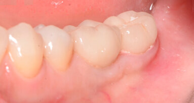 Technique Snake dans le traitement des défauts des tissus mous péri-implantaires postérieurs