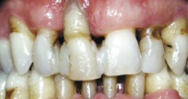 Kde končí parodontologie a nastupuje implantologie