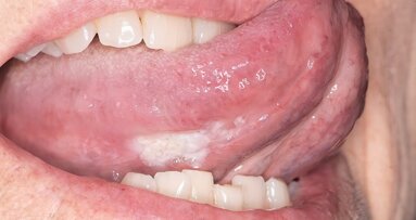 Un ensayo clínico frena lesiones orales precancerosas