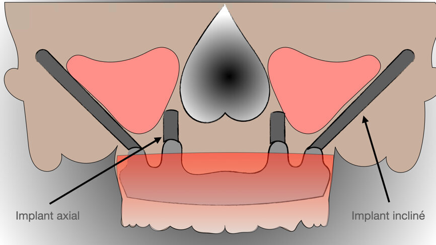 Fig. 2 : Prothèse maxillaire sur implants axiaux et inclinés.