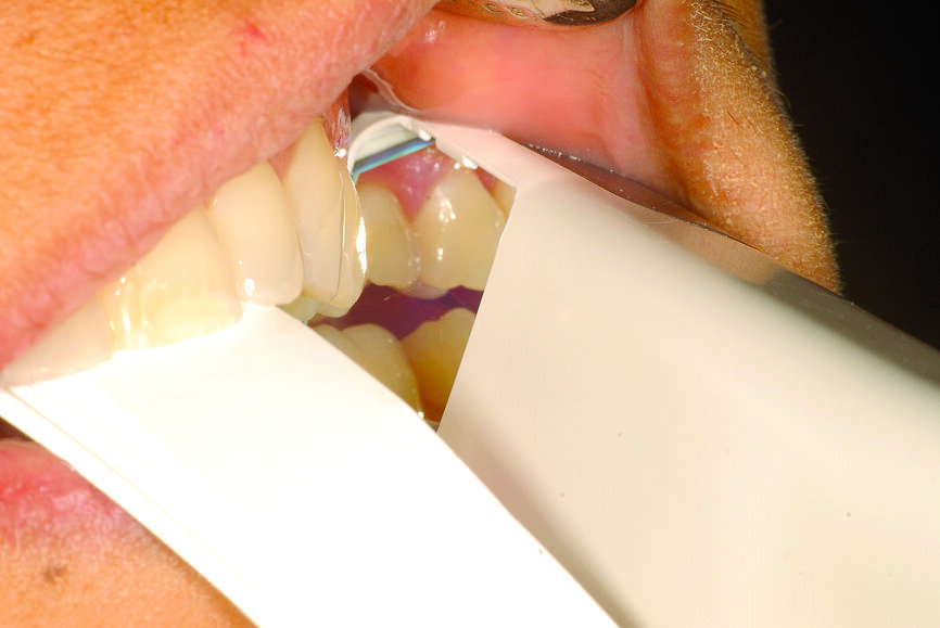 Fig. 24: Centric relation recording using an intra-oral scanner while the mandible is stabilised by a leaf gauge at the desired vertical dimension of occlusion.
