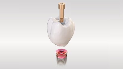 Kooperation von TRI Dental Implants und Amann Girrbach: Implantate ohne Abutment im vollstädig validierten Workflow Kooperation von TRI Dental Implants und Amann Girrbach: Implantate ohne Abutment im vollstädig validierten Workflow