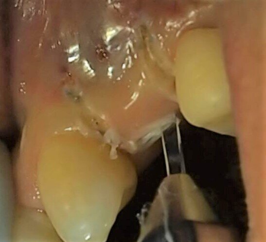 Fig. 9 - Caso clinico 2. Incisione dei tessuti molli: si apprezza il controllo dell’emostasi.