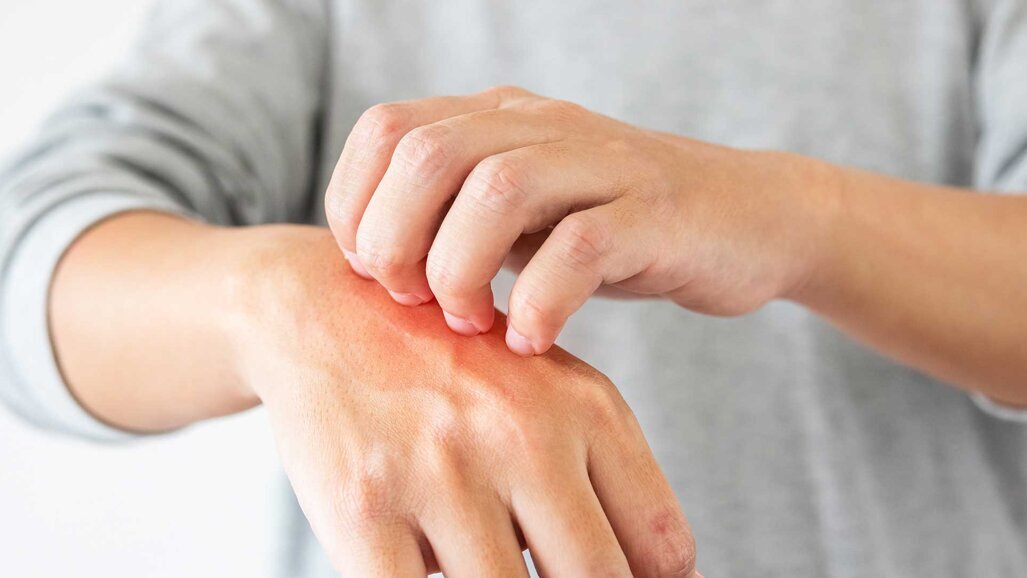 Studie bestätigt Zusammenhang zwischen Zahnagenesie und Dermatitis