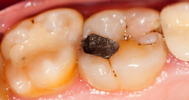 Meer gezondheids- en milieurisico’s door kwik