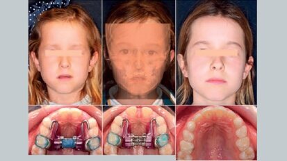 Nuevas Tecnologías y Técnicas en Ortodoncia y Ortopedia Dentofacial Digital