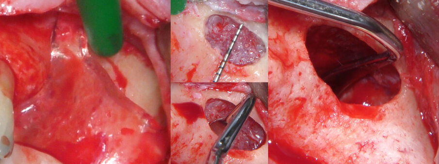 Fig. 5 - La preparazione dell’antrostomia e lo scollamento e sollevamento della membrana sinusale. Dopo avere disegnato l’antrostomia sulla parete vestibolare, si procede alla sua esecuzione e al sollevamento della membrana. 
