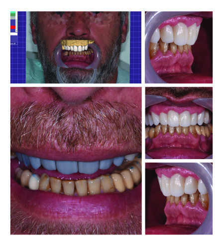 Kolaž slika 2:  Prikaz inicijalnog dizajna, prototipa mosta i realnog izgleda definitivne nadoknade. Odnos prema mekim tkivima i antagonistima. (U saradnji sa dr spec. stomatološke protetike Srđanom Konatarom, Specijalistička stomatološka ordinacija Dentalux)