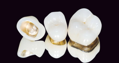 Un nouvel alliage Platine/Palladium/Or pour les restaurations conjointes