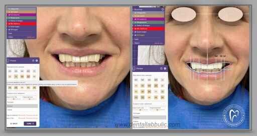 Slika 2: Motivacioni dizajn osim oblika pacijent može videti različite nijanse boja, na slici se vide dve varijante boje A3 i A1