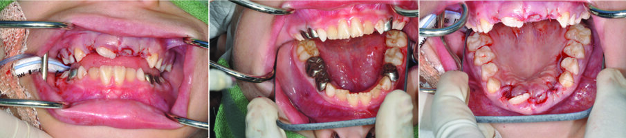 Figs. 11 (a, b & c). Show the immediate post operative views 