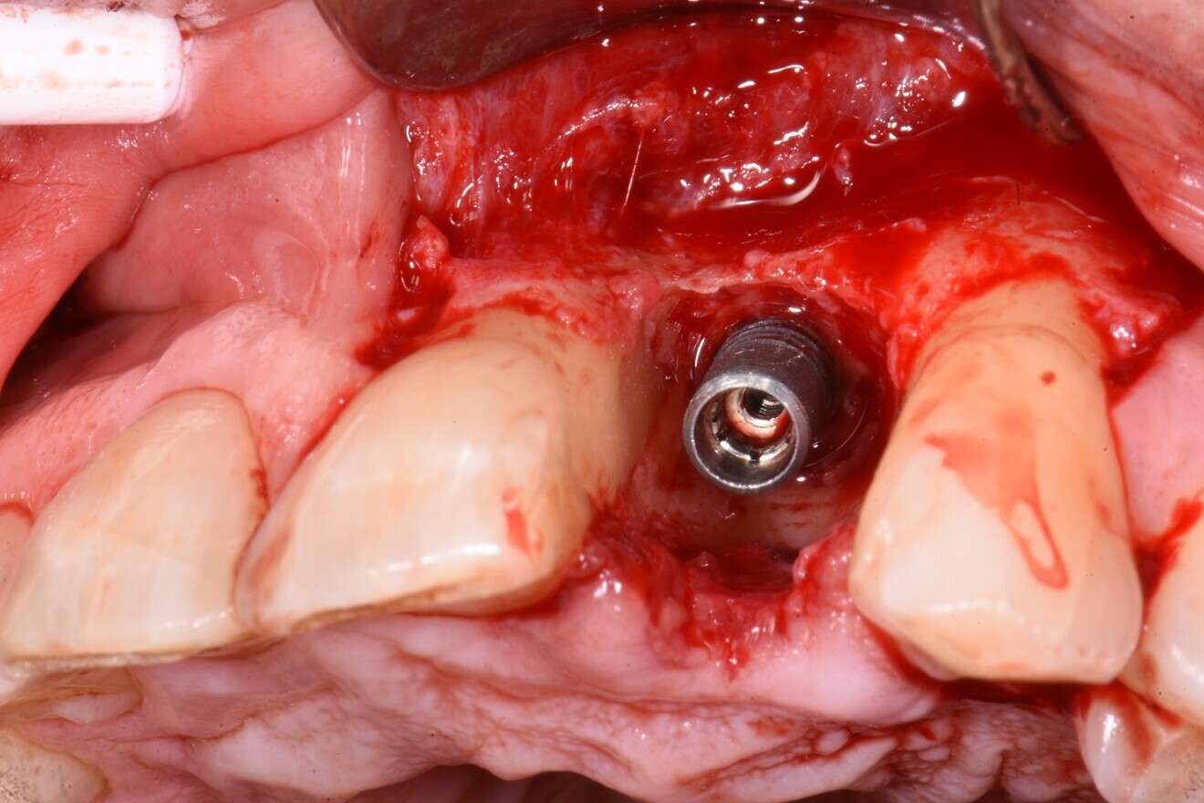 Fig. 18: Clinical photograph of the defect. 