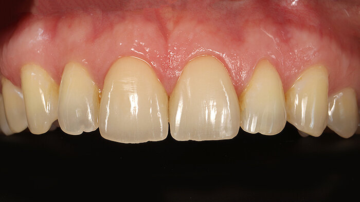 Fig. 15: Both veneers integrated completely and naturally into the aesthetic zone.