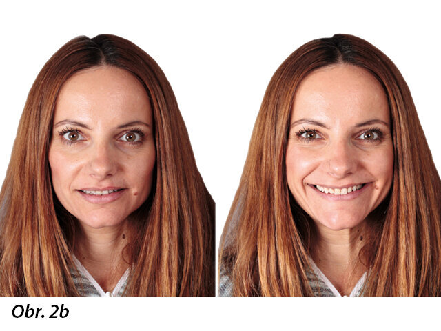 Obr. 1: Úvodní fotografie předních zubů před ortodontickou léčbou.