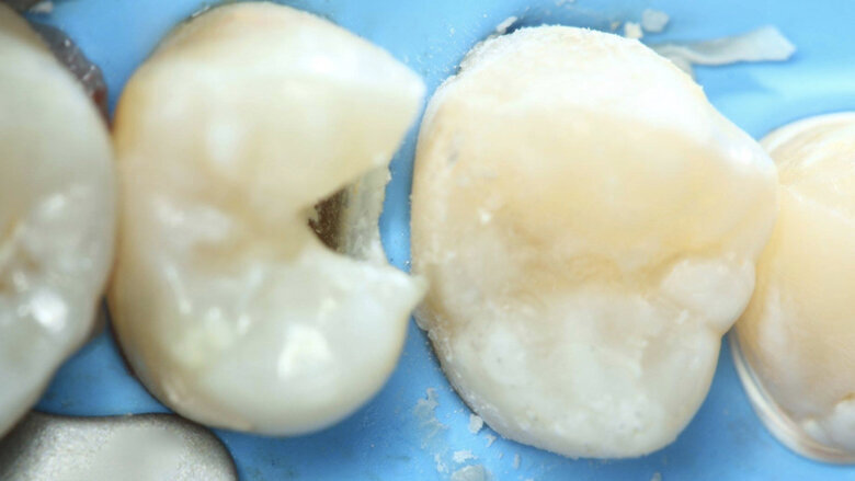 Figura 27. El material restaurador usado es el ionómero de vidrio encapsulado EQUIA.