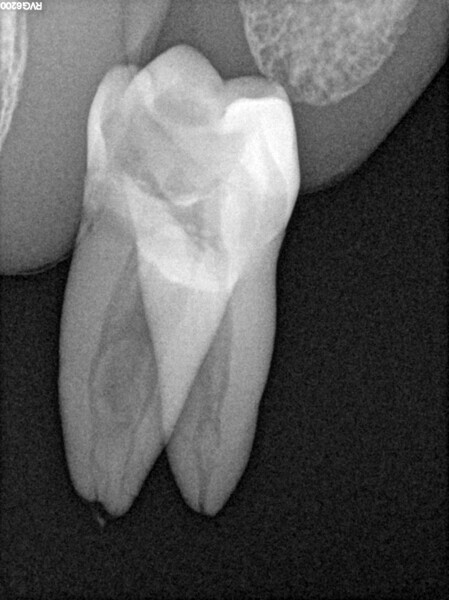 Fig. 1: Pre-op radiograph of a mandibular molar showing the isthmus, ramifications and lateral canals.