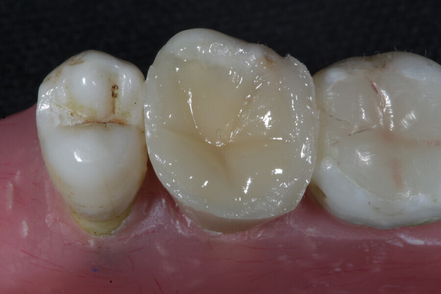 Fig. 42b: A layer of a fibre-reinforced flowable composite (Fibrafill FLOW) is applied over the membrane cube.