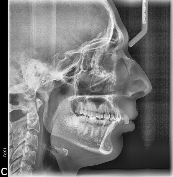 Fig. 4: Cephalometric radiograph.