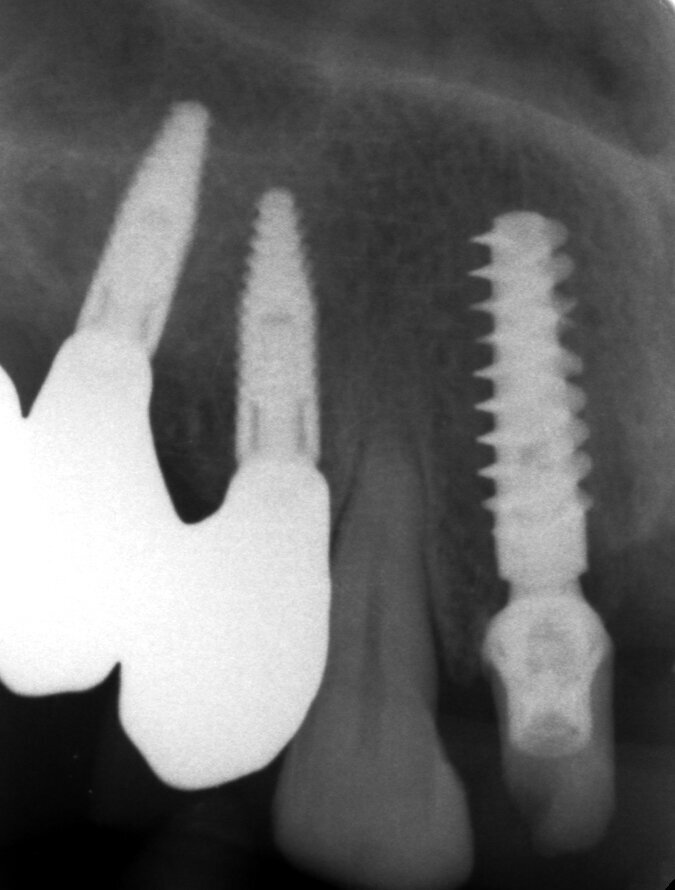 Fig. 69 - Rx finale.