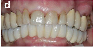 Fig. 14d: Occlusal, frontal and lateral views on the day of delivery, showing healthy peri-implant mucosal conditions (a) and the final CAD/CAM restoration in situ (b–e).