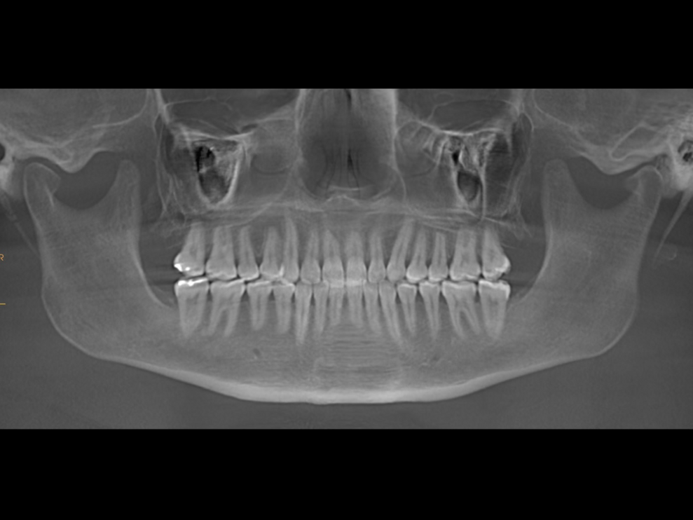 Fig. 26: Post-treatment dental panoramic tomogram.