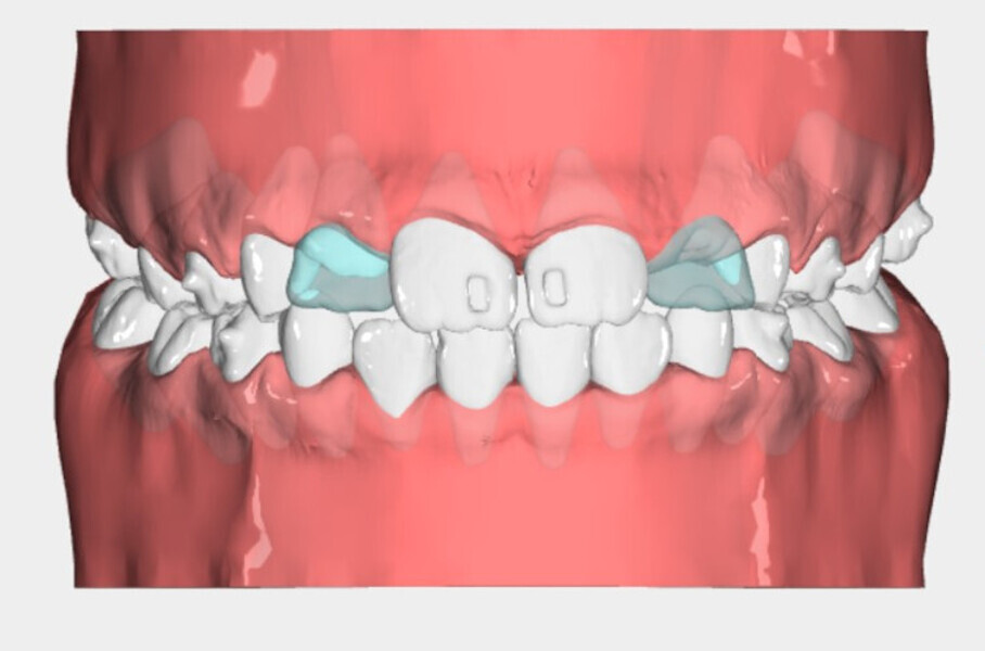 Fig. 8b: Nuvola View images of the impressions for the first phase of therapy, the second phase, the finishing design and the final re-evaluation of the case.