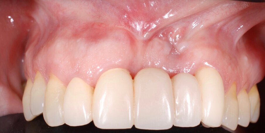 Fig. 14 - Finalizzazione protesica.