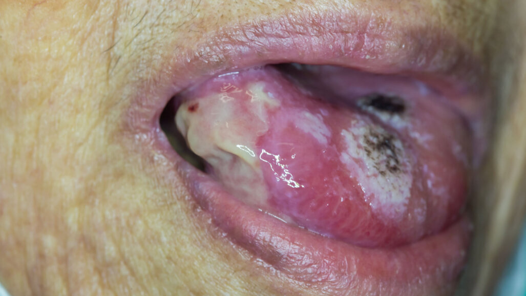 New guidance for care of patients with oral potentially malignant disorders