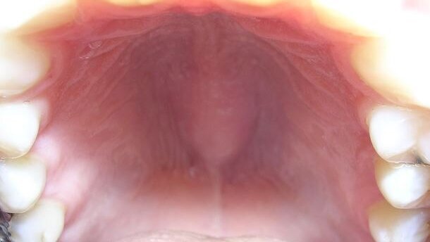 Występowanie wałów żuchwowych i podniebiennych – przegląd piśmiennictwa