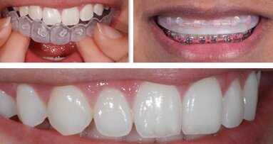 Aclaramiento dental con alineadores para Ortodoncia Aclaramiento dental con alineadores para Ortodoncia