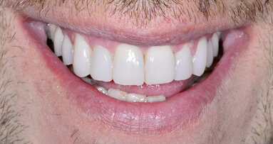 The next generation of  the composite veneering system