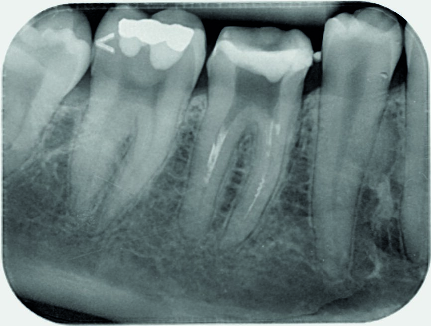 Fig. 1: Initial radiographic status of tooth #46