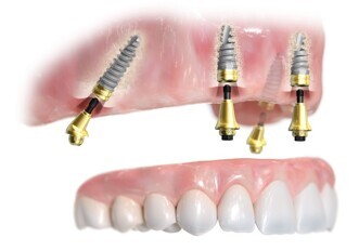 Nobel Biocare – All-on-4 treatment concept