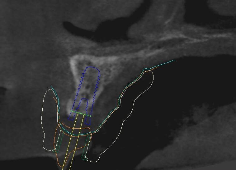 Fig. 10_La visione ingrandita del sito implantare esalta alcuni elementi che hanno contribuito nella scelta della posizione, dei materiali e della tecnica chirurgica esecutiva. Si nota Ion bianco il margine della dima chirurgica, in verde il profilo mucoso, in arancio la forma in sezione assiale della corona protesica in blu il contorno dell’impianto in Zirconia pure Ceramic e in giallo in tragitto di connessione che consentirà l’avvitamento della corona finale.
