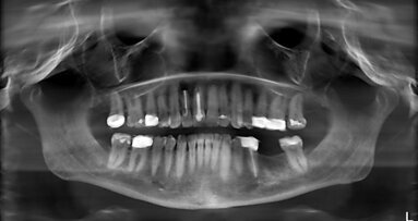 Un concept prothétique implanto-porté d’avant-garde pour une réussite et une stabilité tissulaire à long terme