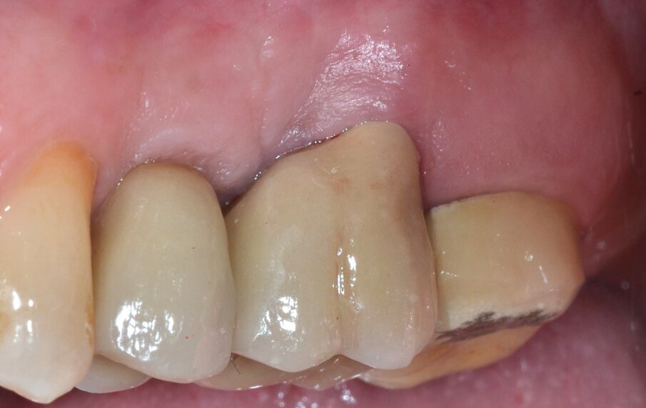 Fig. 9 - Protesizzazione definitiva mediante corona in metallo-ceramica (aspetto buccale).