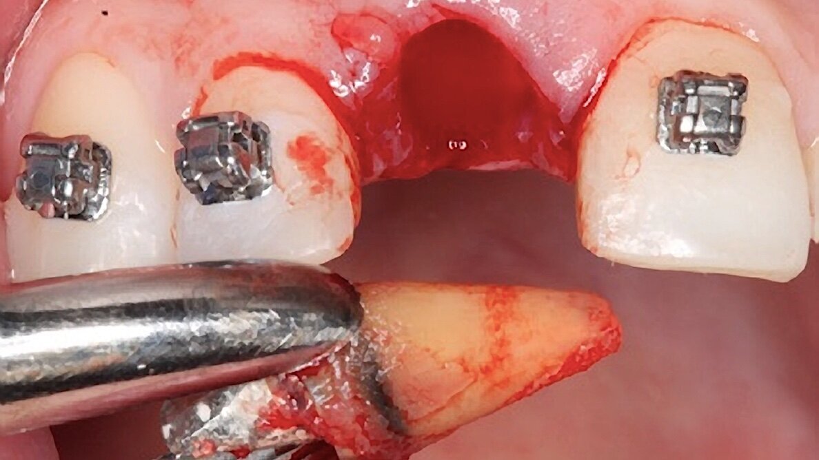 Cómo lograr cirugías exitosas y evitar complicaciones
