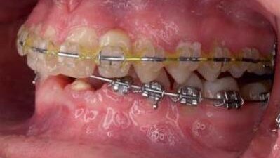 Rehabilitacja przypadku hipodoncji i mikrodoncji poprzez skojarzone leczenie ortodontyczne i implantoprotetyczne