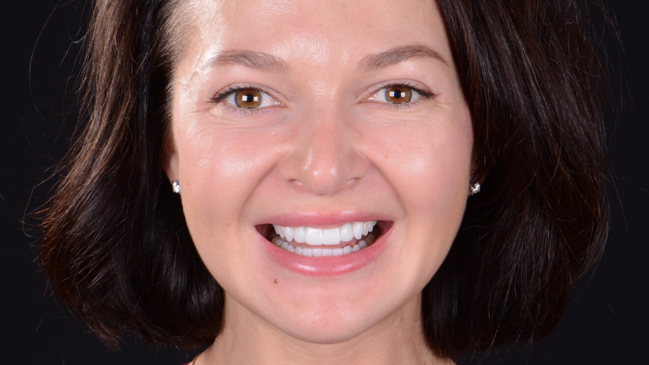 Fig. 6: Extra-oral evaluation of the planned aesthetic outcome using the try-in.