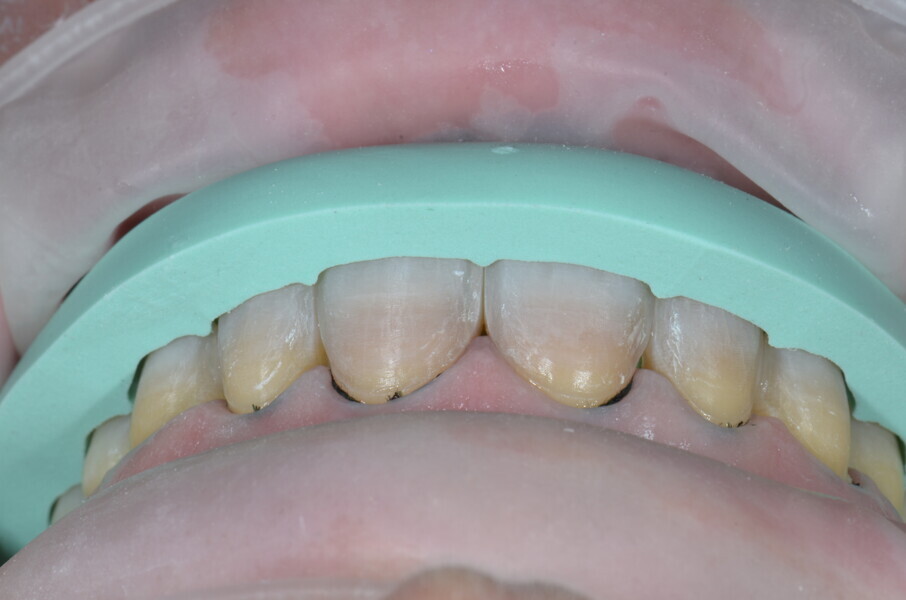 Fig. 8: Sectioned silicone index to check the spaces from the middle thirds to the incisal thirds of the teeth.