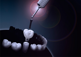 Nobel Biocare – NobelProcera restorations