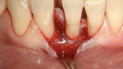 Rigenerazione Parodontale con membrana GUIDOR matrix barrier: difetti intraossei e forcazioni
