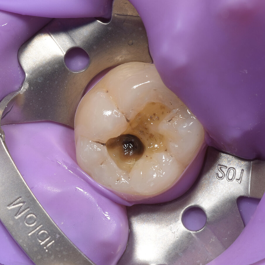 Fig 3: Removal of old amalgam with presence of amalgam “tattoo” at the base  