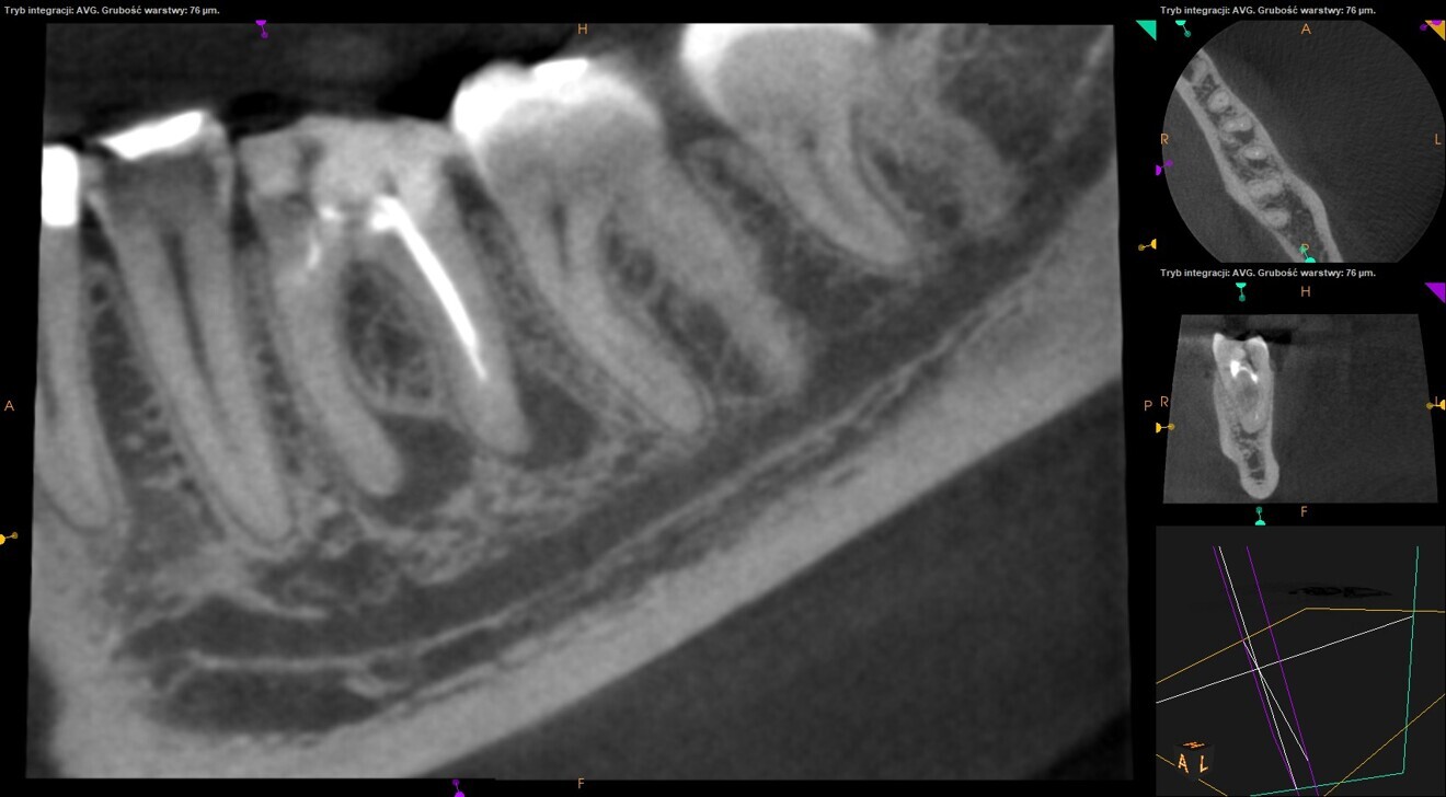 Fig. 26: Pre-op CBCT scan. Two apical lesions visible.