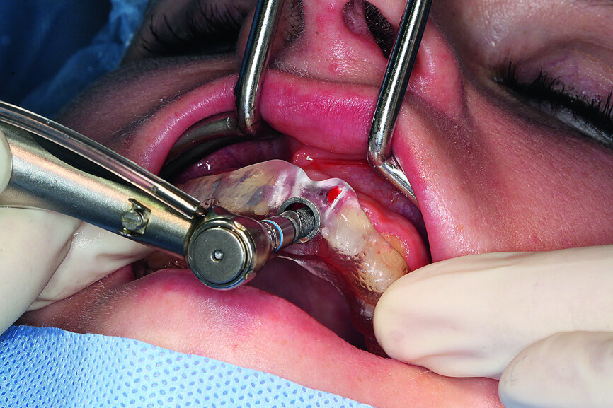 Fig. 9: Preparing the implant bed according to the recommended drill sequence, insertion of the implant using the SICAT surgical guide.